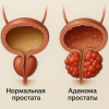Симптомы и лечение аденомы предстательной железы